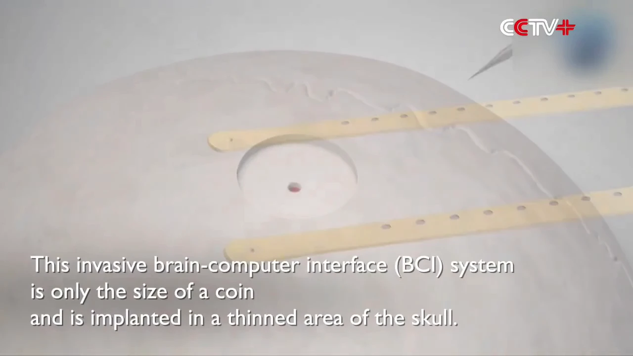 Move Over, Neuralink – China’s Brain Implant Takes the Lead