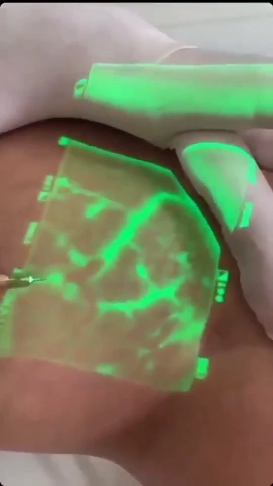 VeinViewer illuminates patients' veins during injections